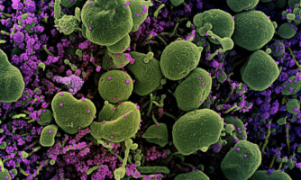 A cell (green) heavily infected with SARS-CoV-2 virus particles (purple).