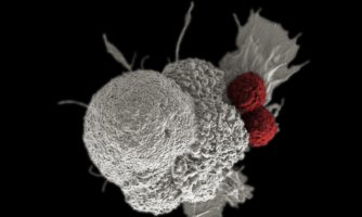 Electron micrograph of oral cancer cell being attacked by two cytotoxic T cells