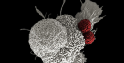 Electron micrograph of oral cancer cell being attacked by two cytotoxic T cells