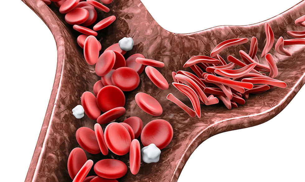 Image of blood cells, some are normal, and others are sickle and causing a blockage.