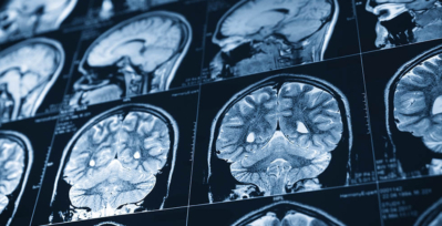 Scans of a human brain showing effects from an ischemic stroke.