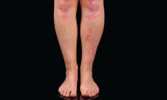 A person's legs with psoriasis patches.